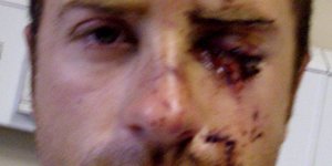 Riaan Burger, wat 4 jaar gelede ernstig by Montegoâ€™s aange-rand is, se snymerke kan hier gesien word terwyl hy in die hospitaal behandel is.